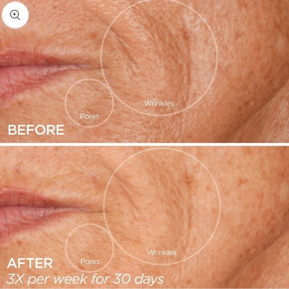 GLOPRO Facial Microneedling Tool - Picture 4 of 10